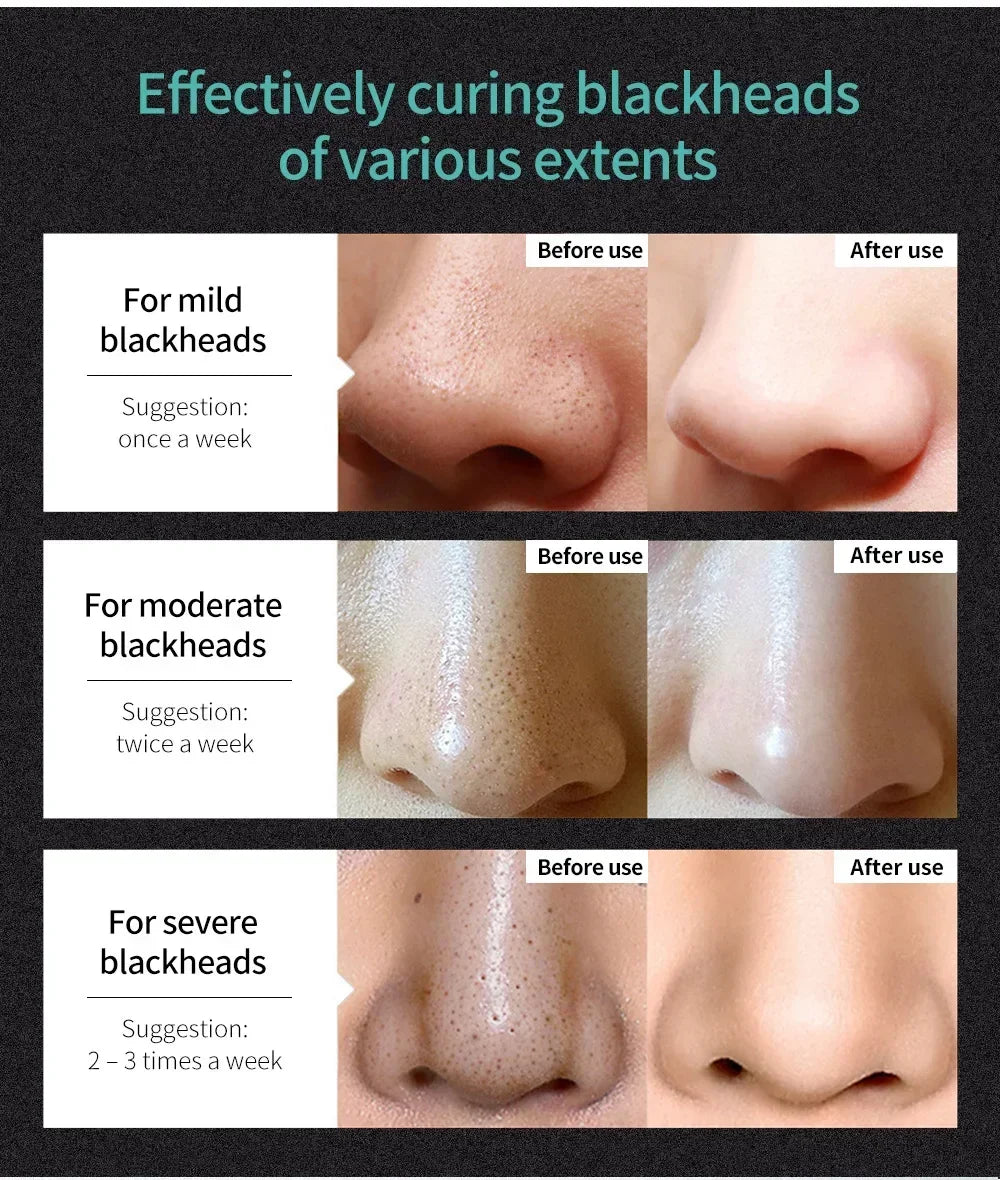LANBENA Blackhead Remover Mask – Deep Pore Cleansing & Skin Brightening - Vitaléaa