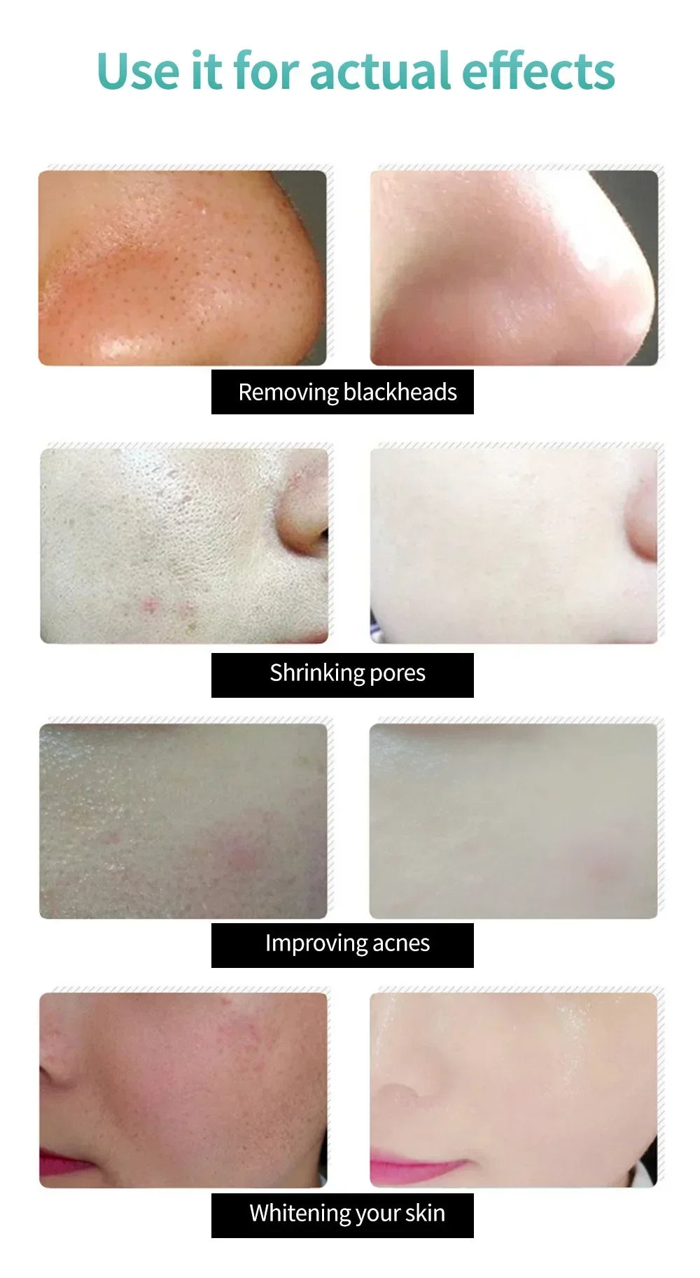 LANBENA Blackhead Remover Mask – Deep Pore Cleansing & Skin Brightening - Vitaléaa