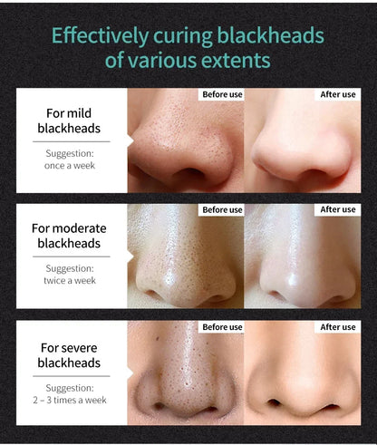 LANBENA Blackhead Remover Mask – Deep Pore Cleansing & Skin Brightening - Vitaléaa